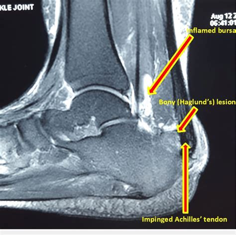 Mri Image Of Ankle And Foot Showing Posterosuperior Bony Spurring Of