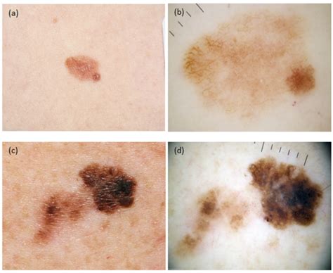 Two Examples Of Macroscopic Images A And C And Dermoscopic Images B