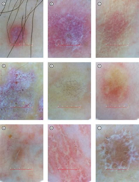 Figure 1 From Dermoscopic Patterns In Active And Regressive Lichen