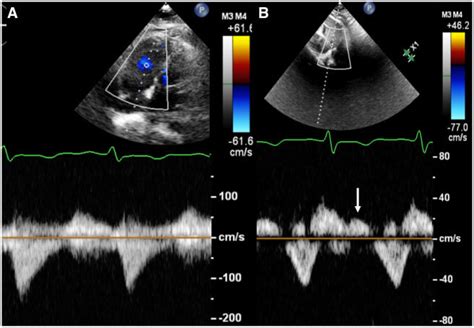 Spectral Doppler Of The Tricuspid Regurgitation A Continuous Wave