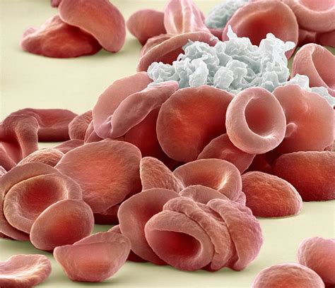 Too little clotting can cause excessive bleeding from blood clots: Blood Clotting, Sem Photograph by Steve Gschmeissner