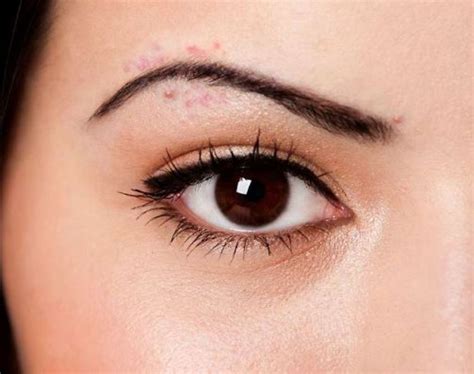 What Does Pimples Between Eyebrows Mean 10 Things Acne Means About
