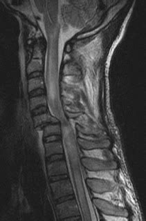 Cervical Spine Trauma Sumer S Radiology Blog