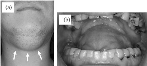 A Clinical Pre Operative Presentation Of Submental Swelling B