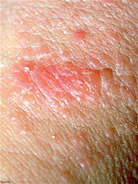 It is characterized by a visible change in the color and texture of the skin, this condition when applied to the rash infested skin part; Identify the common skin rashes in adults and treat them ...