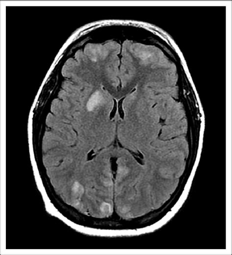 Magnetic Resonance Image Of The Brain Axial T2 Weighted Fluid