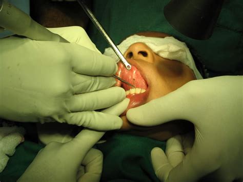 Tongue Tie Surgery By Laser Dr Paulose