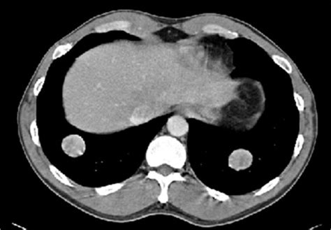 Chest Ct Showing Bilateral Metastatic Tumor Nodules In The Lung Bases