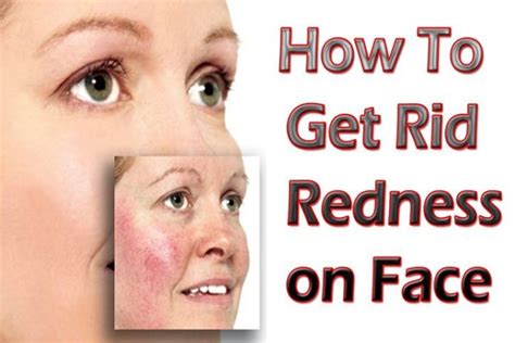 12 Easy And Effective Remedies To Get Rid Of Redness Of Face Naturally