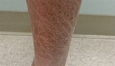 Skin Scales On Legs