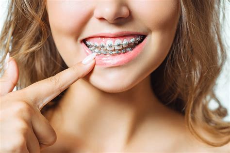 Understanding The Parts And Function Of Braces Springfield Oh