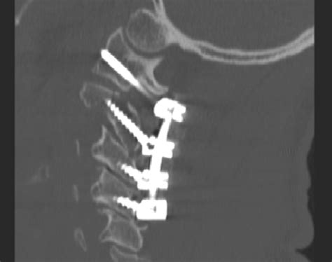 Sagittal Computed Tomography Of A C2 Pedicle Screw Download