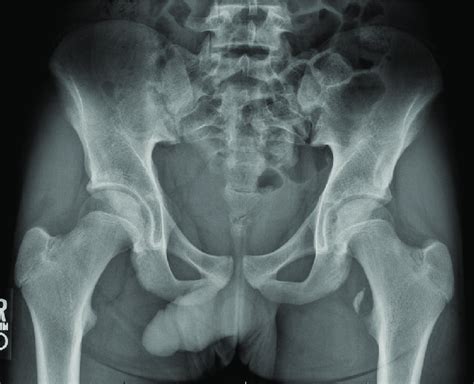 One of the bony prominences toward the near end of the thighbone (the femur). Anteroposterior radiograph demonstrating left hip lesser ...