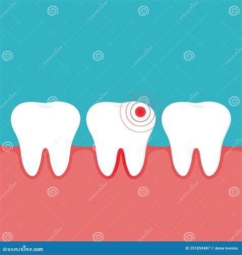 Illustration Of An Inflamed Tooth And Gum And Healthy Teeth Gingivitis