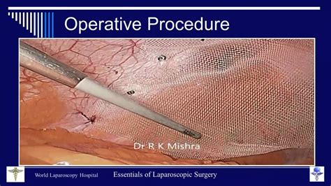 Dr R K Mishra S Lecture On Laparoscopic Repair Of Ventral Hernia Youtube