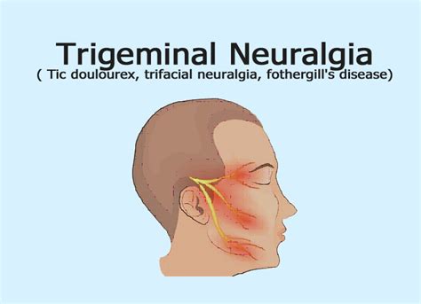Trigeminal Neuralgia Focus Dentistry