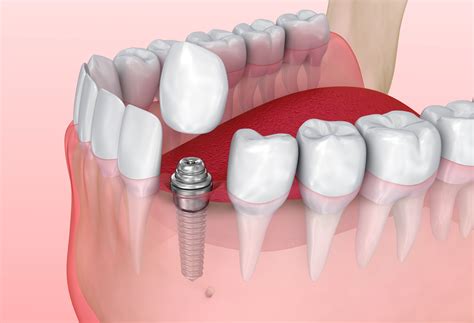 Dental Crowns For Single Tooth Replacement Queens Ny