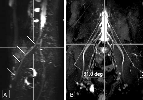 3d Mr Neurography Of The Lumbosacral Plexus Obtaining Optimal Images