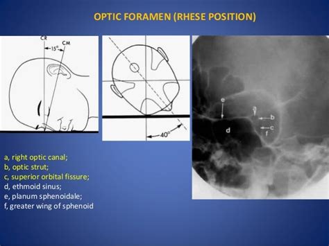 Orbit Imaging Anatomy