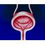 Illustration Of A Female Bladder With Cystitis Photograph By John Bavosi