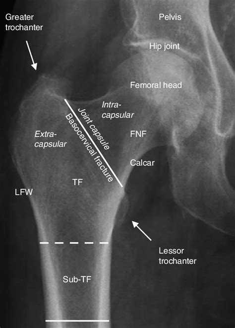 1 Antero Posterior Radiograph Of The Right Side Proximal Femur Showing