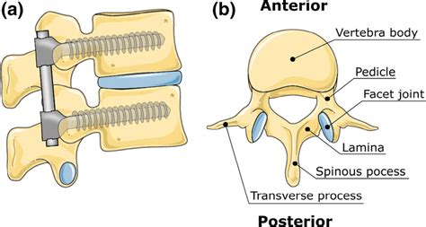 A Schematic Representation Of A Fixation Of The Adjacent Vertebrae With Download Scientific