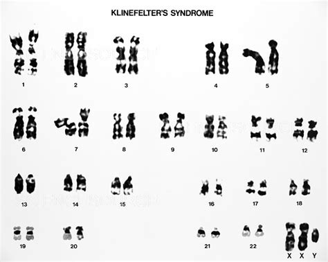 Photograph Klinefelter S Syndrome Karyotype Science Source Images Sexiz Pix