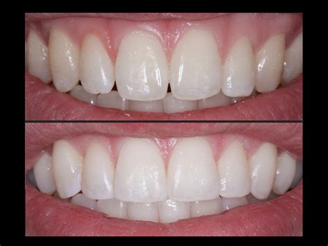 Dental Tips Smile Dentistry All You Need To Know About Tooth Bonding