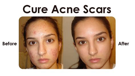How To Cure Acne Scars On Face Naturally Overnight Youtube