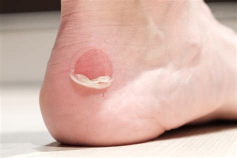 School Shoes Causing Blisters Umina Podiatry