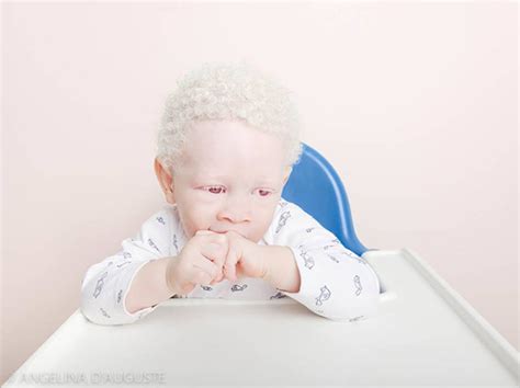 Vulnerable Dreamlike Portraits Of People With Albinism Feature Shoot