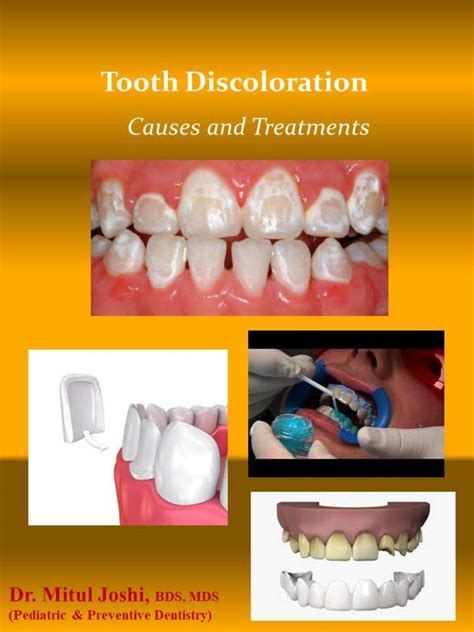 Tooth Discoloration Causes And Treatments By Mitul Joshi Goodreads