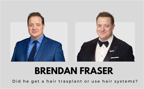 Brendan Fraser Hair Loss Battle Over The Years