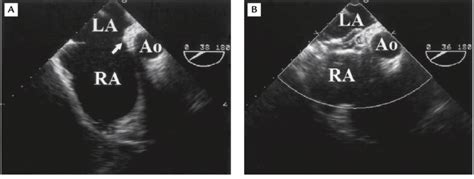 Transesophageal Echocardiography Shows Atrial Septal Defect With