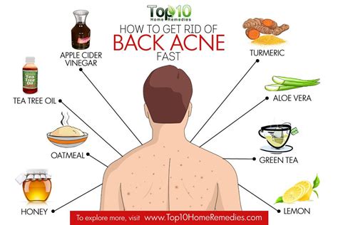 How To Get Rid Of Back Acne At Home Emedihealth How To Get Rid Of
