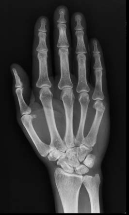 Boxer S Fracture Radiology Case Radiopaedia Org