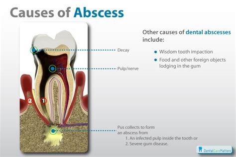 How To Get Rid Of Abscess In Gums Iso Mass Xtreme Gainer Gnc
