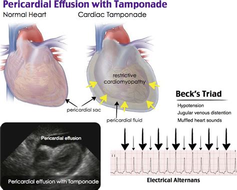 Rosh Review Cardiac Medical Knowledge Pericardial Effusion