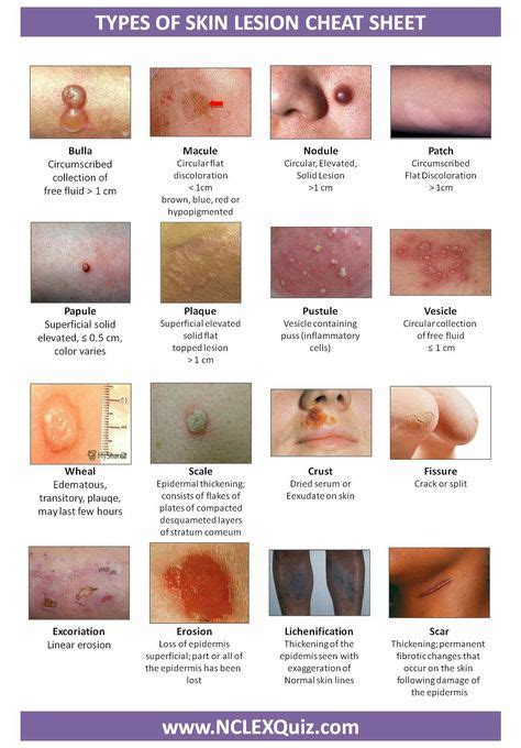 Macules Vs Papules Primary Lesions Pediatrics Pinterest Medical