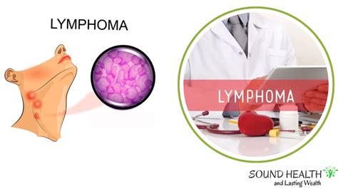 Final Stages Of Mantle Cell Lymphoma Prognosis Treatment Options And