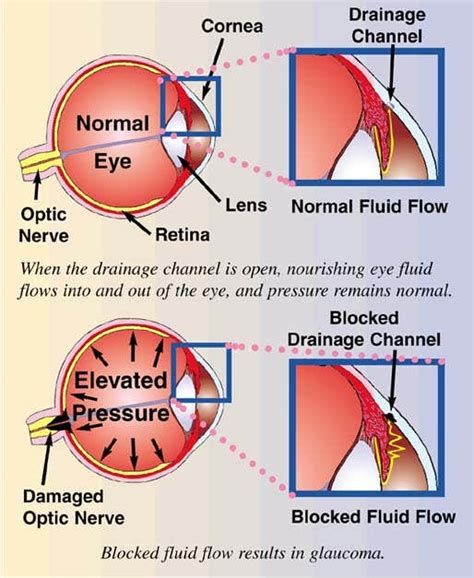 Learn about the types of glaucoma and whether you are. Glaucoma Care: Fundamental For Vision - Goggles4u.com