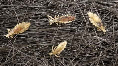 New Mutant Lice Resistant To Common Treatments In 25 States Including