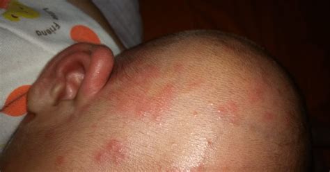 Pada beberapa kasus, bintik merah terjadi akibat reaksi alergi terhadap sesuatu. Ketahui Jenis Bintik Merah Pada Kulit Bayi - UMAHLIYU