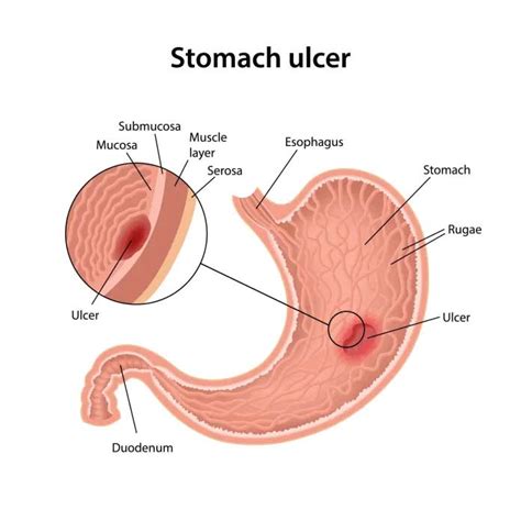 What Are Stomach Ulcers Stomach Ulcer Symptoms Causes Treatment