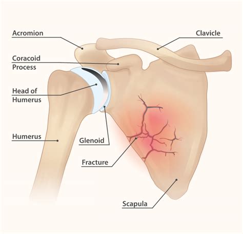 Another possible reason for pain at this location is inflammation of the head of the pancreas, the part of the pancreas located on the right side of the upper abdomen. Pain in and Under the Shoulder Blade: Your Guide to Pain ...