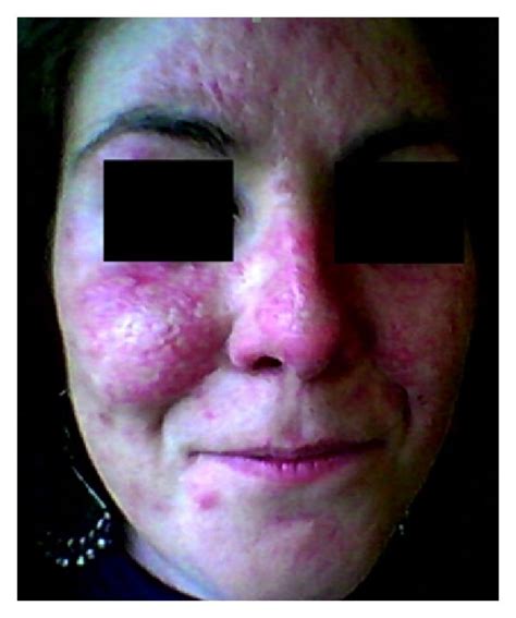 A Scle Cutaneous Eruption Which Infiltrates Forehead Cheeks And