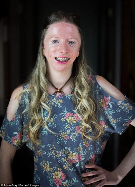 California Woman With Craniofacial Disorder Embraces Look Daily Mail Online