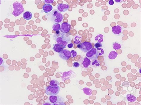 Peripheral Blood Findings In Juvenile Myelomonocytic Leukemia 5
