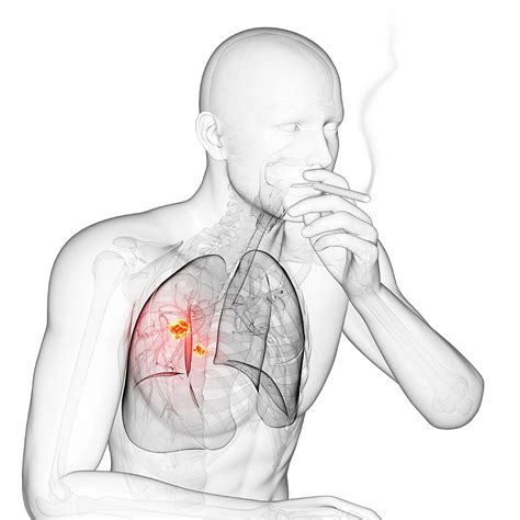 lung cancer due to smoking photograph by sciepro science photo library