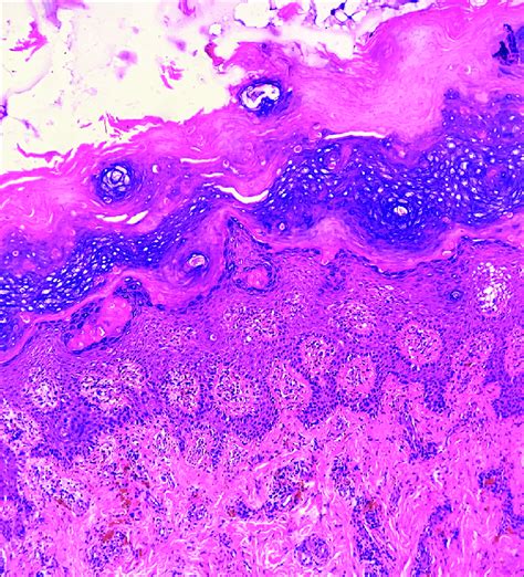 Hyperkeratosis Focal Papillomatosis And Variable Acanthosis And